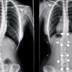 Dos radiografías frontales de columna colocadas lado a lado, con una curvatura lateral más marcada en la imagen izquierda que en la derecha.