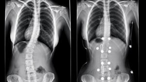 Dos radiografías frontales de columna colocadas lado a lado, con una curvatura lateral más marcada en la imagen izquierda que en la derecha.