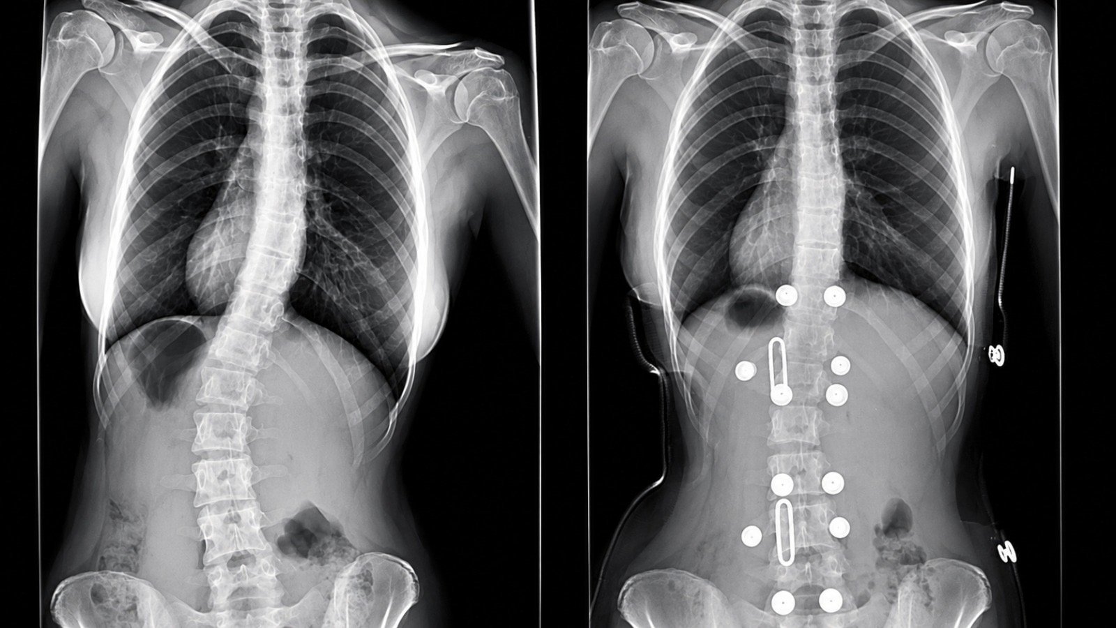 Dos radiografías frontales de columna colocadas lado a lado, con una curvatura lateral más marcada en la imagen izquierda que en la derecha.